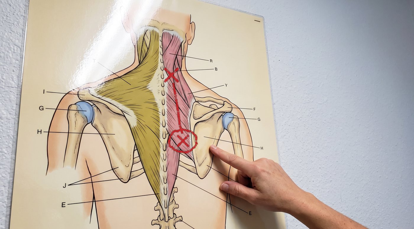 A physical therapy wall chart of the upper back seen from behind, the trapezius reflected on the right to show the rhomboids beneath. A red marker cross at the base of the neck, a line running down along the inner edge of the right shoulder blade, and a circle around the gutter where that edge meets the spine.